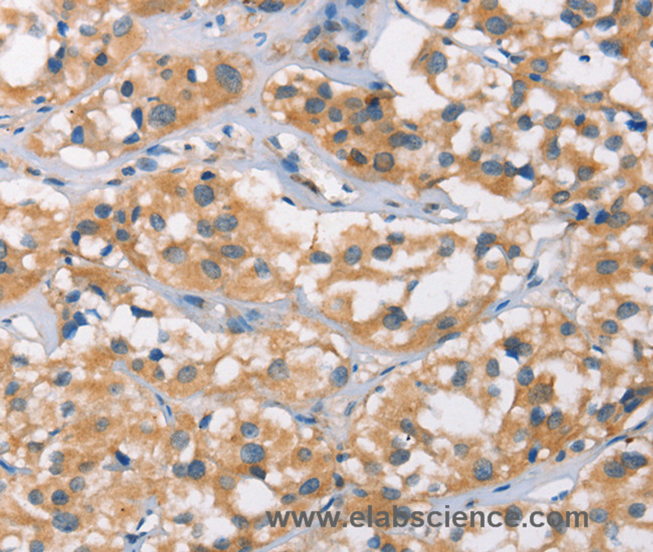 Immunohistochemistry of paraffin-embedded Human thyroid cancer tissue using DSC2 Polyclonal Antibody at dilution 1:35