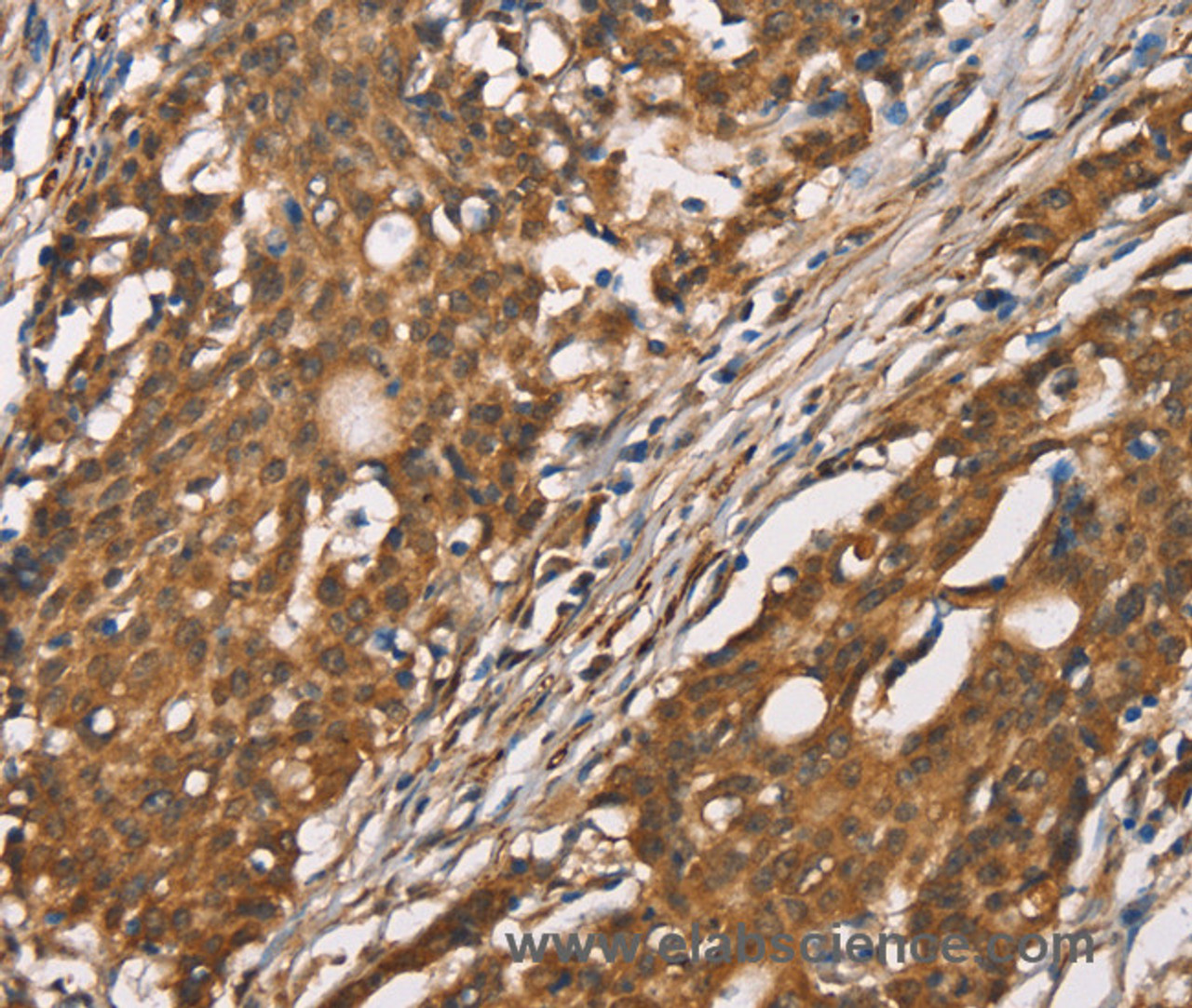 Immunohistochemistry of paraffin-embedded Human gasrtic cancer tissue using DICER1 Polyclonal Antibody at dilution 1:40
