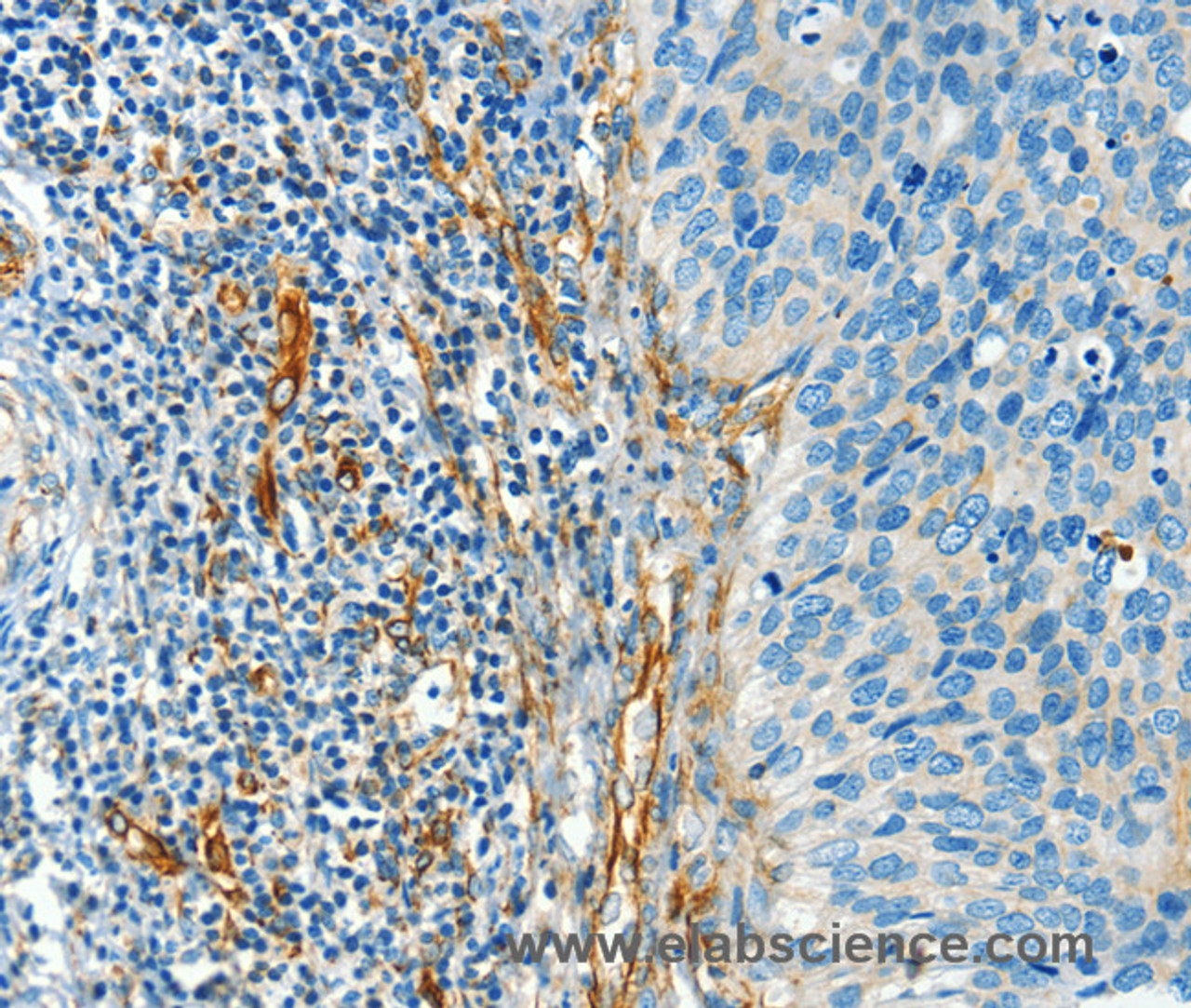 Immunohistochemistry of paraffin-embedded Human cervical cancer tissue using DIO2 Polyclonal Antibody at dilution 1:50