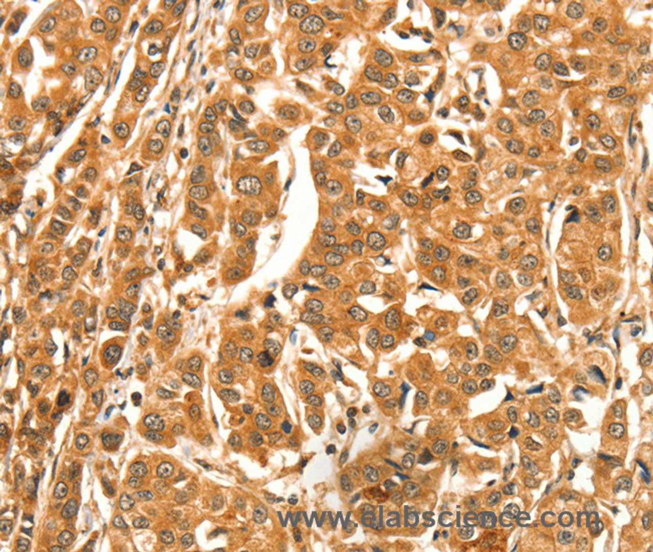 Immunohistochemistry of paraffin-embedded Human breast cancer tissue using DIRAS1 Polyclonal Antibody at dilution 1:52