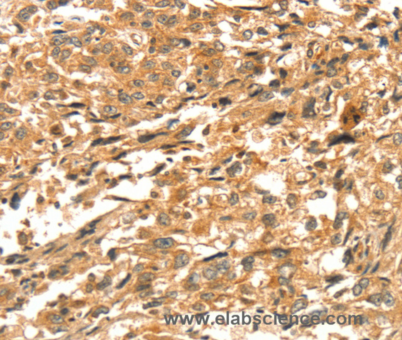 Immunohistochemistry of paraffin-embedded Human esophagus cancer tissue using DIRAS1 Polyclonal Antibody at dilution 1:52