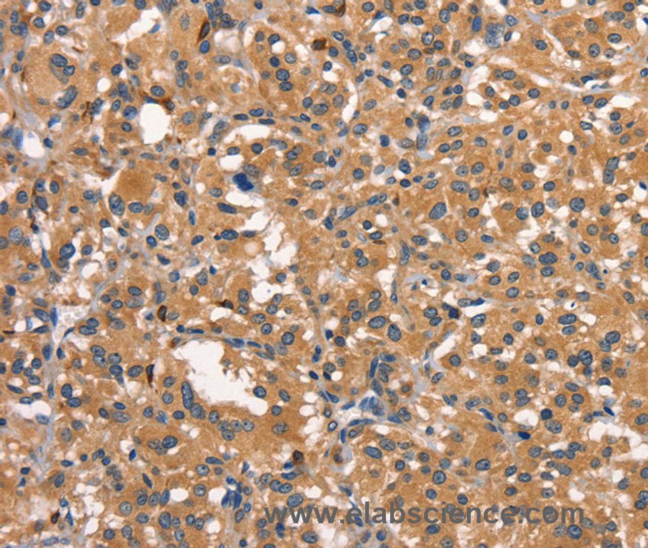 Immunohistochemistry of paraffin-embedded Human thyroid cancer using DNM2 Polyclonal Antibody at dilution of 1:40