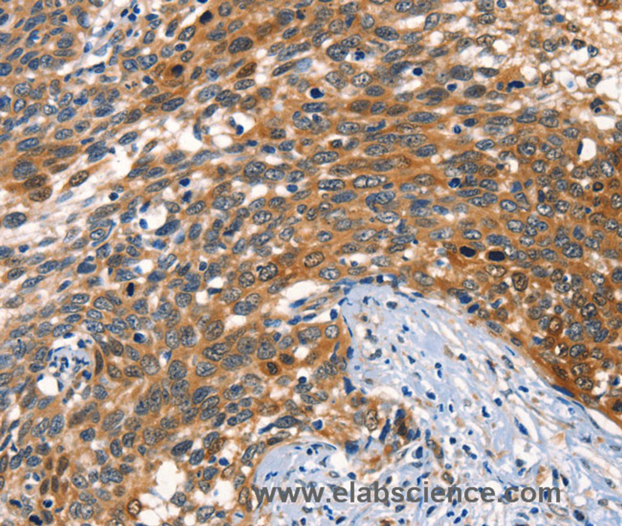 Immunohistochemistry of paraffin-embedded Human cervical cancer tissue using AGO1 Polyclonal Antibody at dilution 1:40