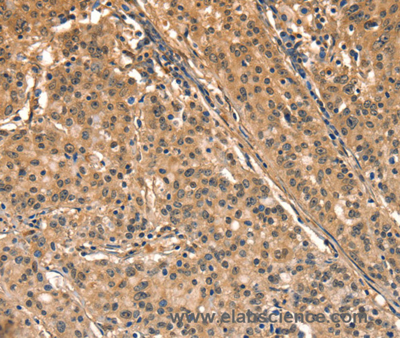 Immunohistochemistry of paraffin-embedded Human gastic cancer using AIMP1 Polyclonal Antibody at dilution of 1:40