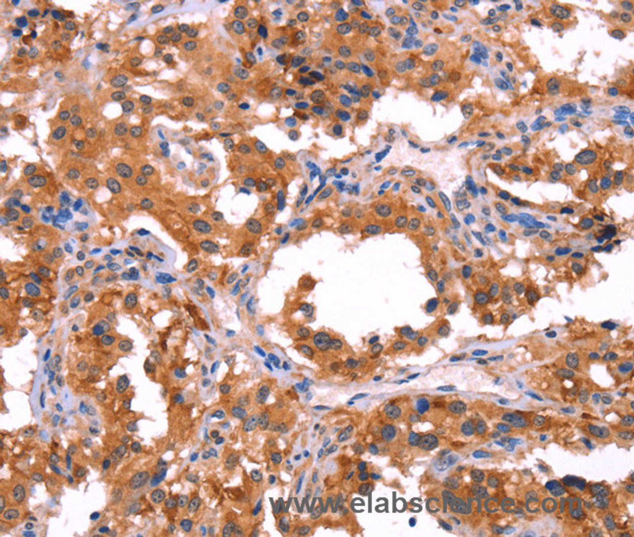 Immunohistochemistry of paraffin-embedded Human thyroid cancer using ERAS Polyclonal Antibody at dilution of 1:40