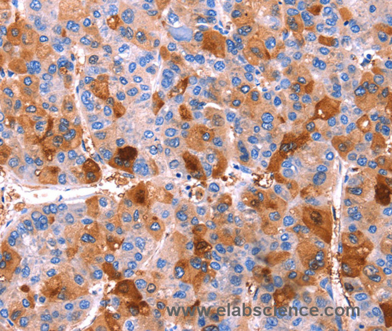 Immunohistochemistry of paraffin-embedded Human liver cancer tissue using ERN2 Polyclonal Antibody at dilution 1:40