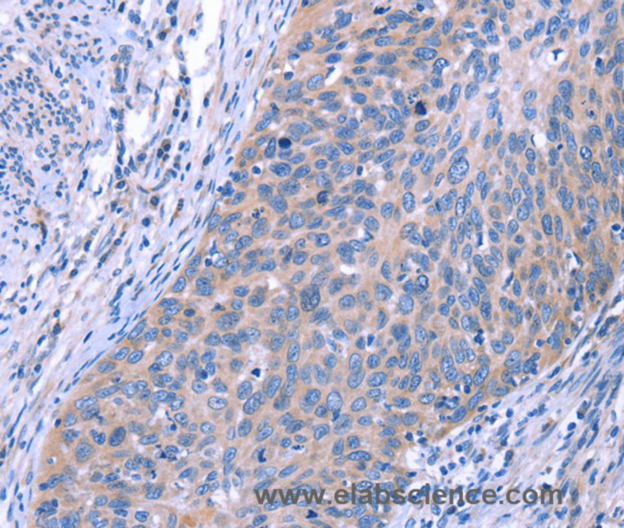 Immunohistochemistry of paraffin-embedded Human cervical cancer using ESPL1 Polyclonal Antibody at dilution of 1:40