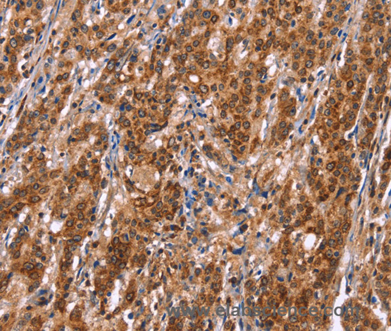 Immunohistochemistry of paraffin-embedded Human gasrtic cancer tissue using TDP2 Polyclonal Antibody at dilution 1:40