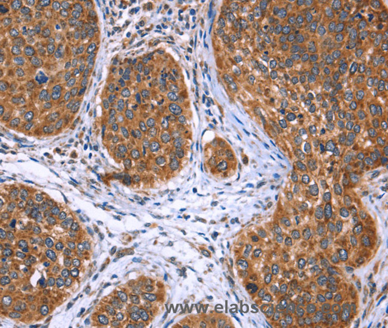 Immunohistochemistry of paraffin-embedded Human cervical cancer tissue using EVC2 Polyclonal Antibody at dilution 1:40