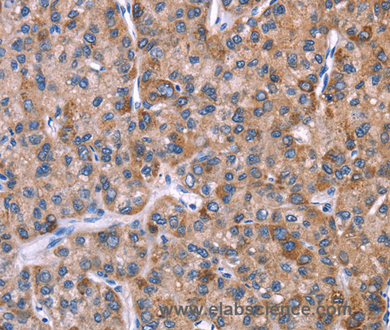 Immunohistochemistry of paraffin-embedded Human liver cancer tissue using EVC2 Polyclonal Antibody at dilution 1:40
