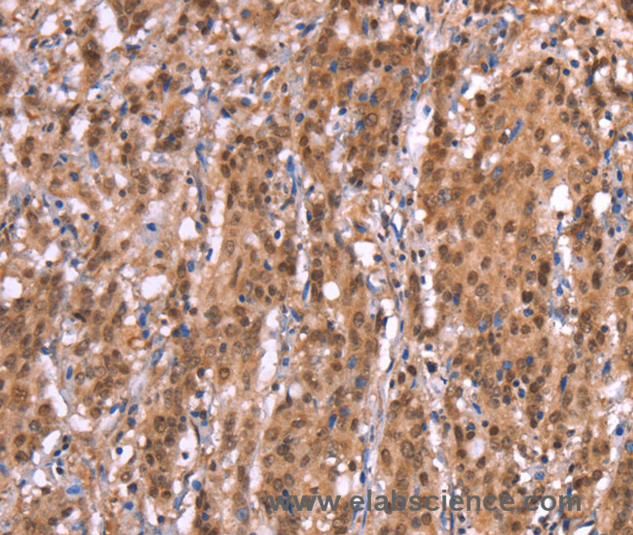 Immunohistochemistry of paraffin-embedded Human gasrtic cancer tissue using AMER1 Polyclonal Antibody at dilution 1:40