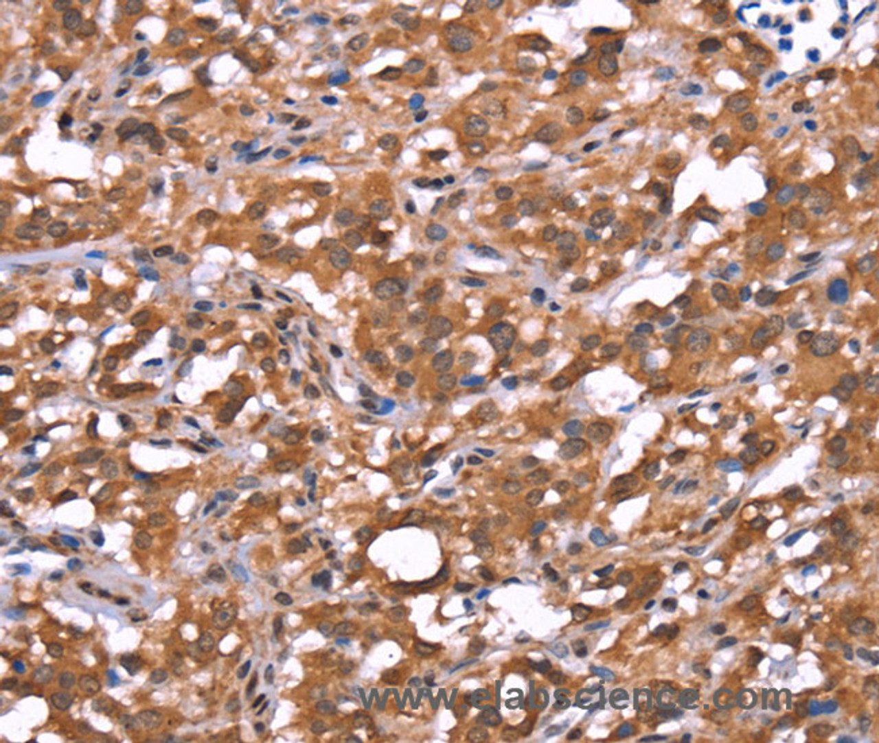 Immunohistochemistry of paraffin-embedded Human thyroid cancer tissue using AMER1 Polyclonal Antibody at dilution 1:40