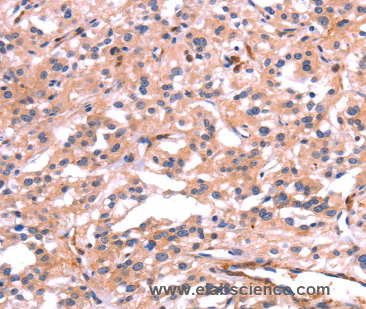 Immunohistochemistry of paraffin-embedded Human thyroid cancer tissue using PTPN13 Polyclonal Antibody at dilution 1:30