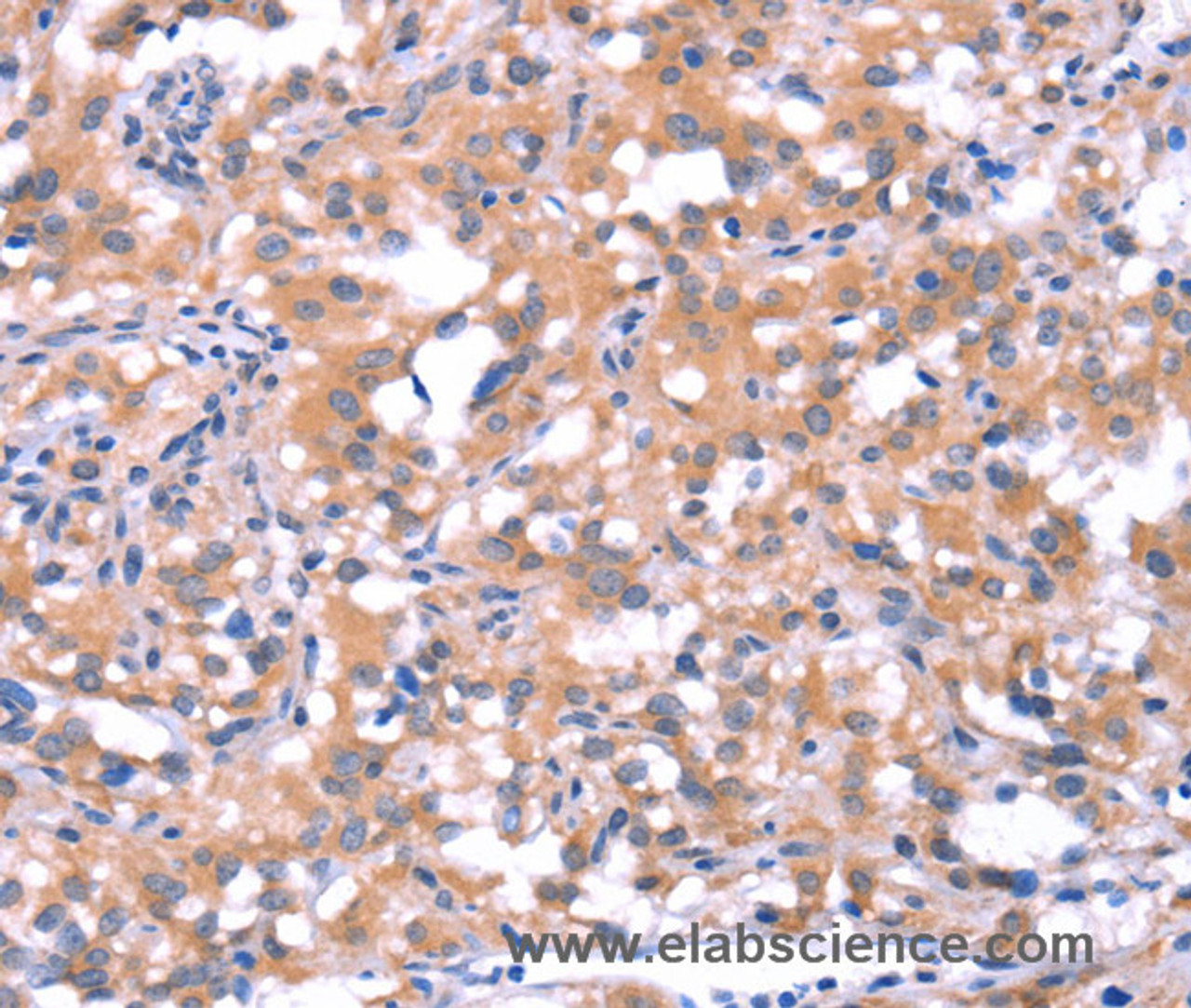 Immunohistochemistry of paraffin-embedded Human thyroid cancer tissue using FAT1 Polyclonal Antibody at dilution 1:40