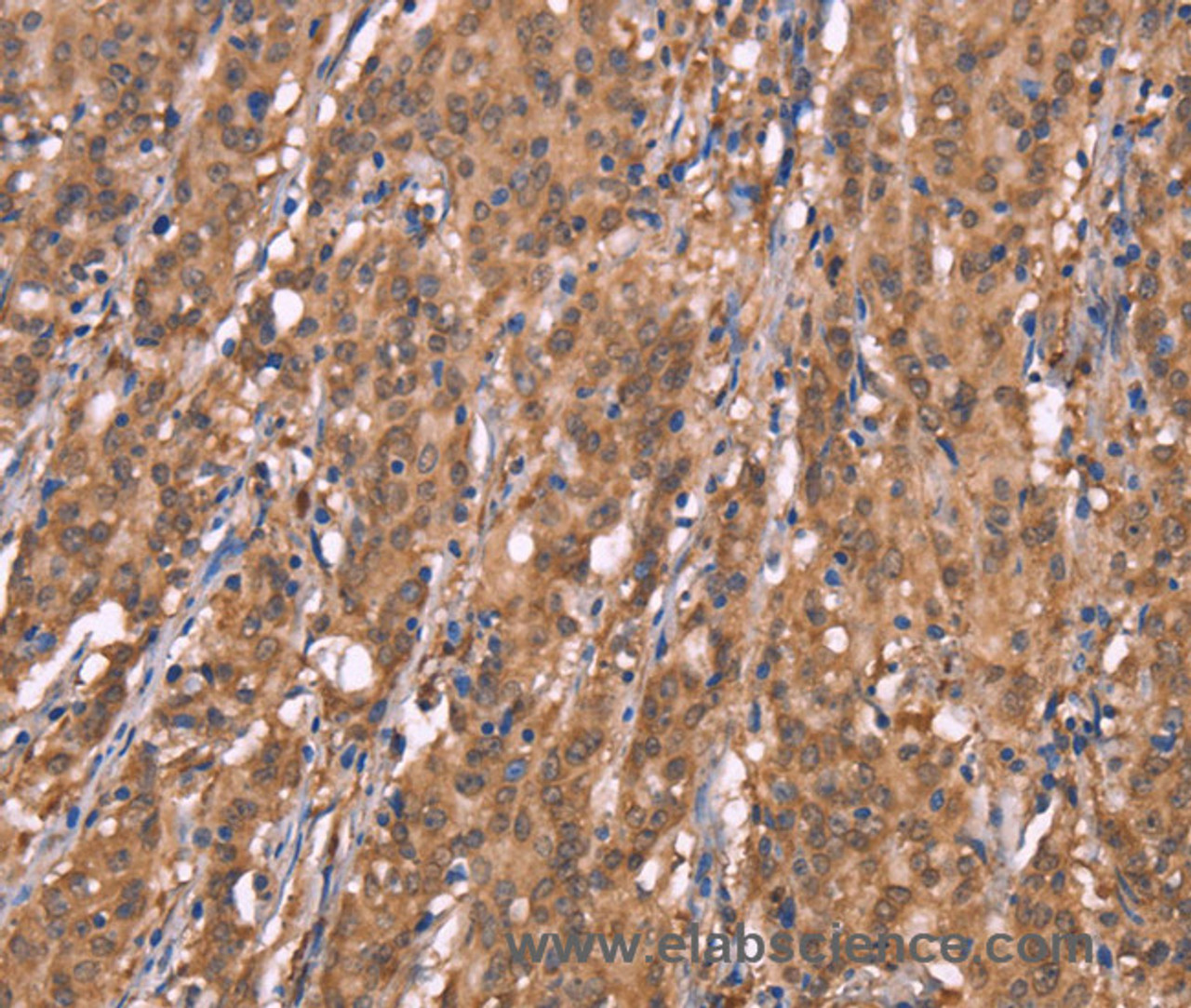 Immunohistochemistry of paraffin-embedded Human gasrtic cancer tissue using FBXO31 Polyclonal Antibody at dilution 1:40