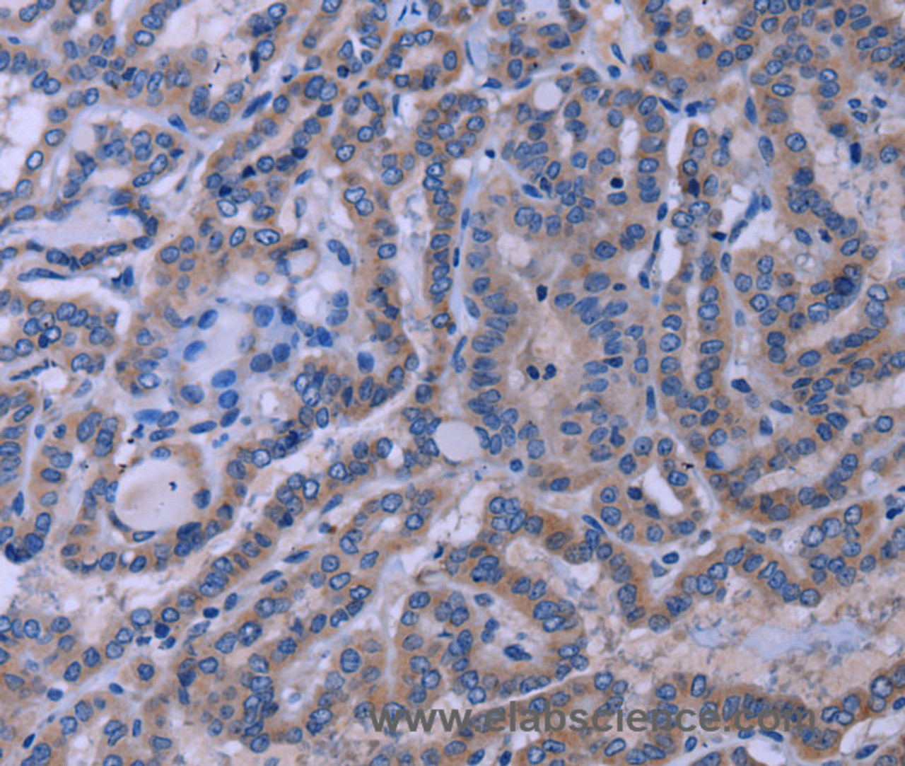 Immunohistochemistry of paraffin-embedded Human thyroid cancer tissue using TUBGCP2 Polyclonal Antibody at dilution 1:50