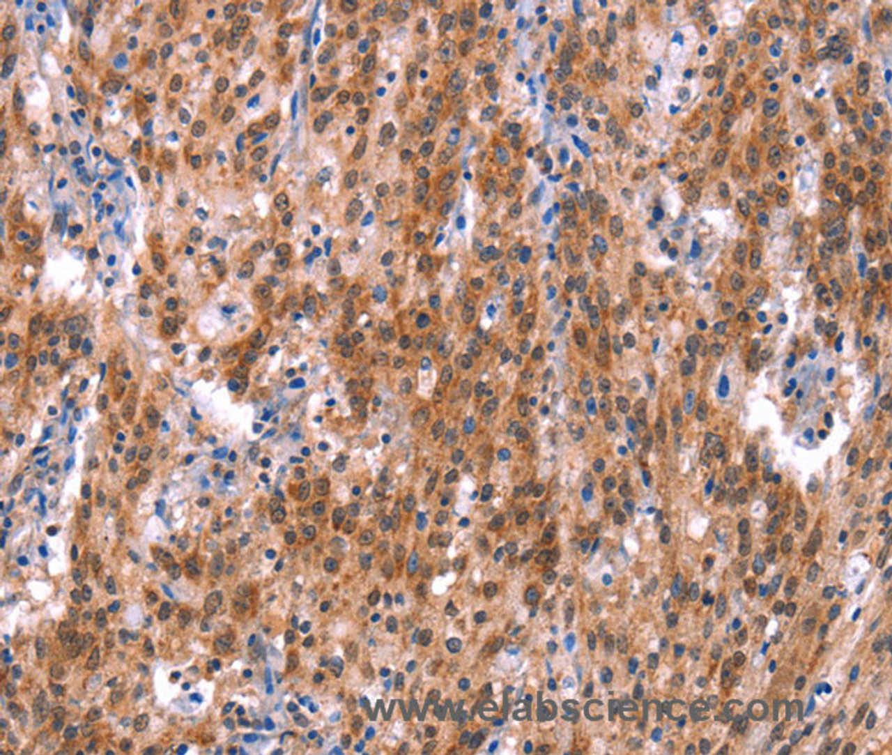 Immunohistochemistry of paraffin-embedded Human gastric cancer using GH1 Polyclonal Antibody at dilution of 1:40