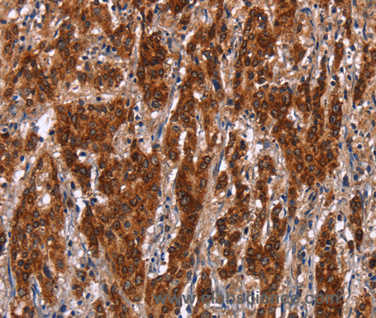 Immunohistochemistry of paraffin-embedded Human gastric cancer tissue using GCKR Polyclonal Antibody at dilution 1:50