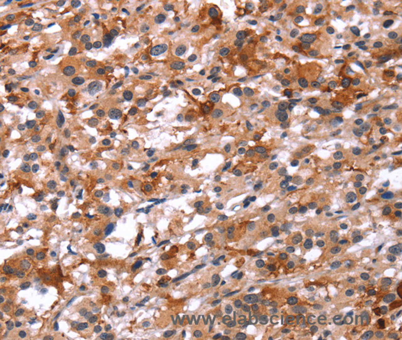 Immunohistochemistry of paraffin-embedded Human thyroid cancer using Glucagon Receptor Polyclonal Antibody at dilution of 1:40