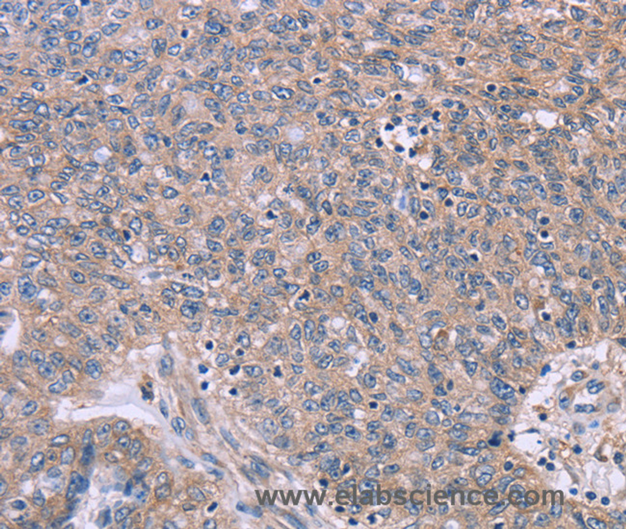 Immunohistochemistry of paraffin-embedded Human ovarian cancer tissue using IL3RB Polyclonal Antibody at dilution 1:40