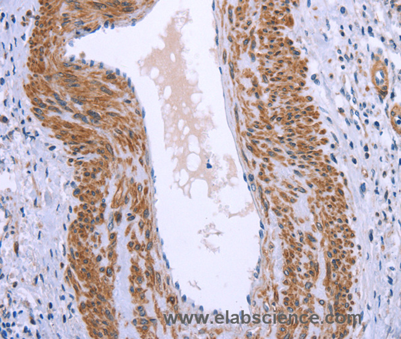 Immunohistochemistry of paraffin-embedded Human cervical cancer tissue using GNPAT Polyclonal Antibody at dilution 1:40