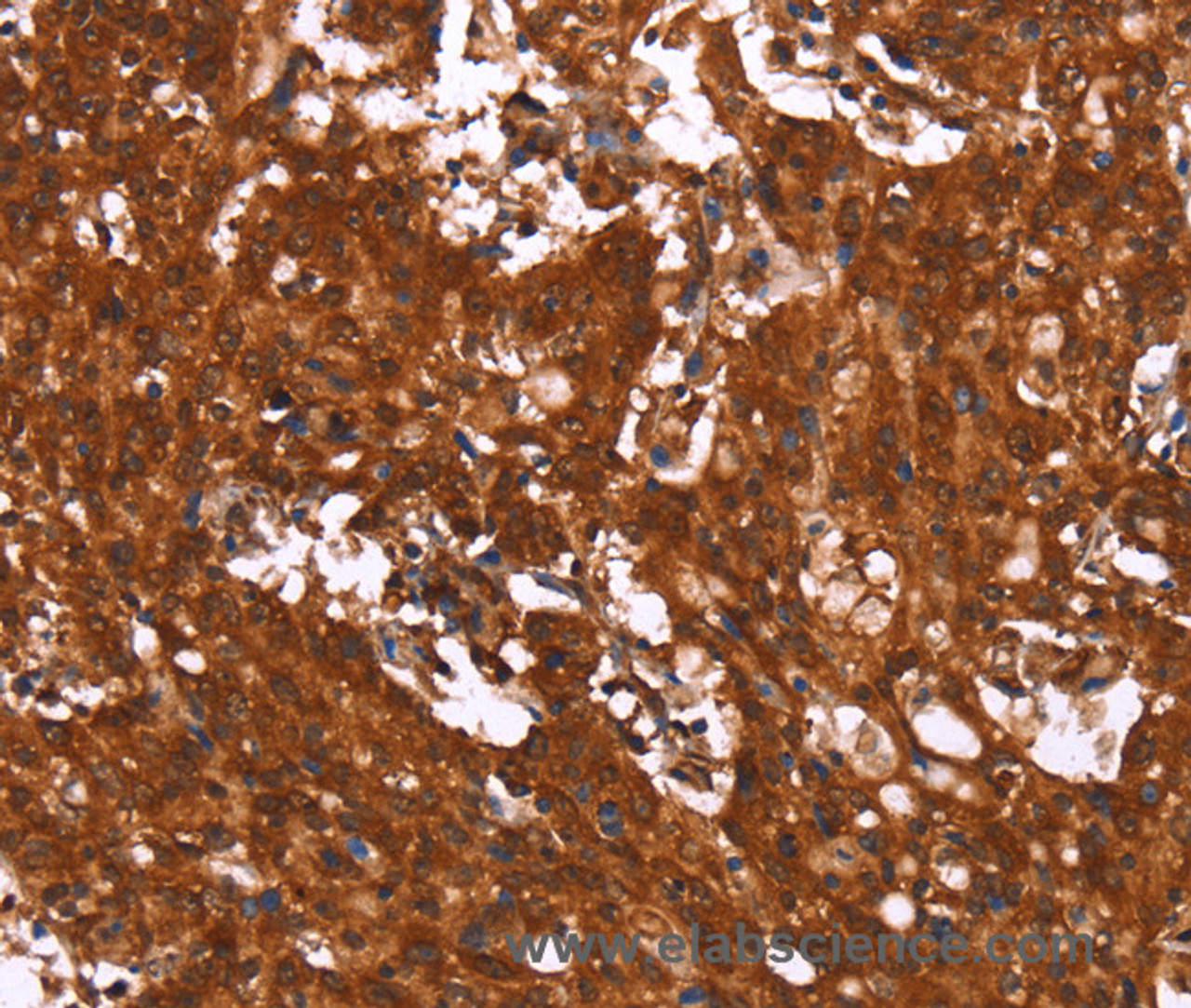 Immunohistochemistry of paraffin-embedded Human gasrtic cancer tissue using HCAR2 Polyclonal Antibody at dilution 1:40