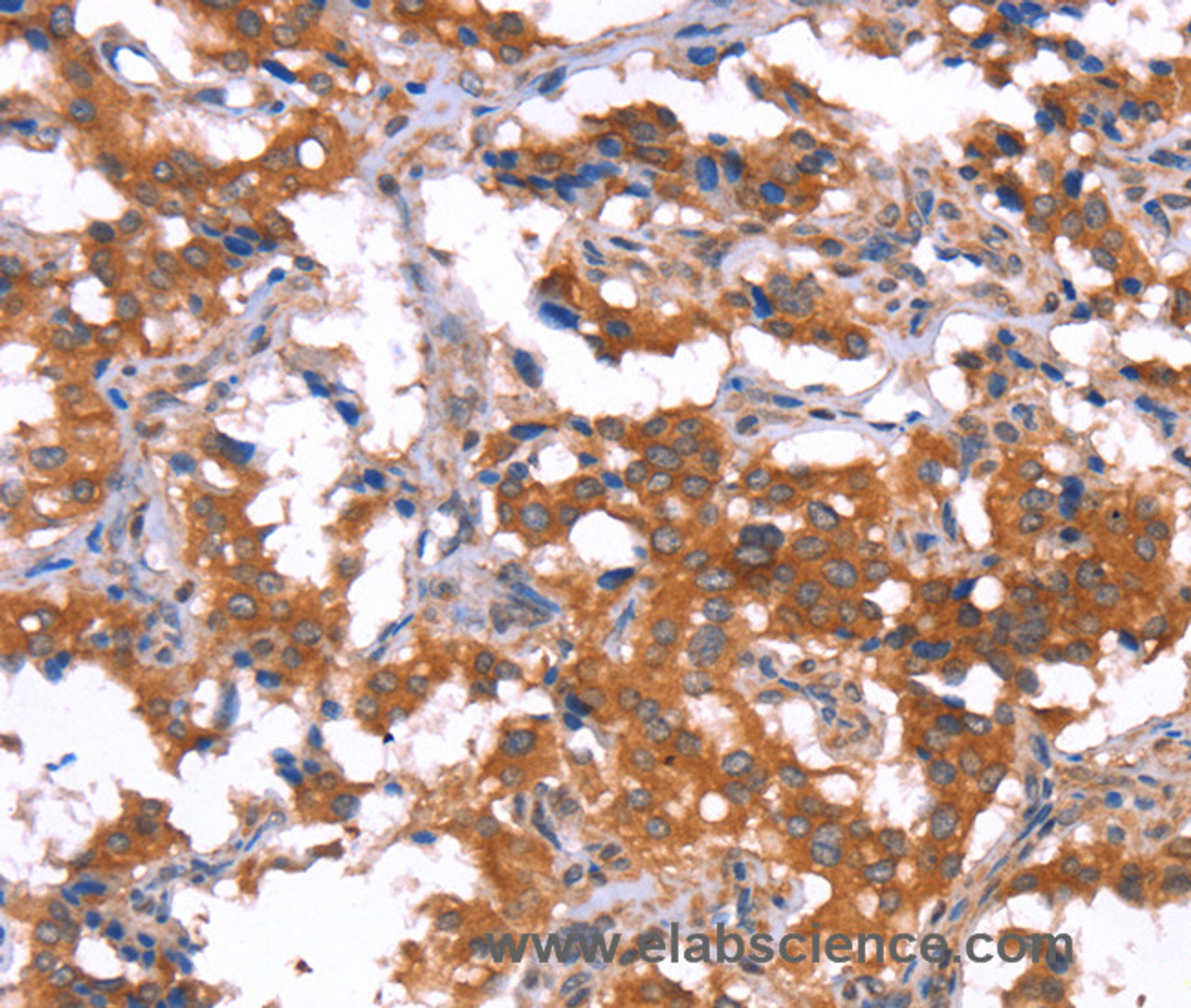 Immunohistochemistry of paraffin-embedded Human thyroid cancer tissue using HCAR2 Polyclonal Antibody at dilution 1:40