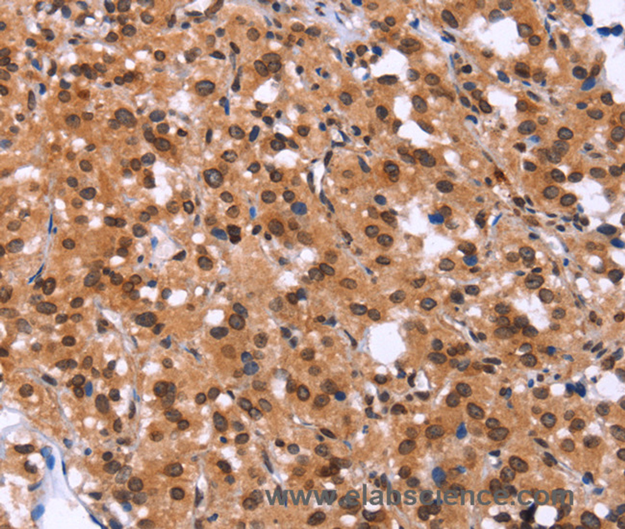 Immunohistochemistry of paraffin-embedded Human thyroid cancer tissue using GPR124 Polyclonal Antibody at dilution 1:40