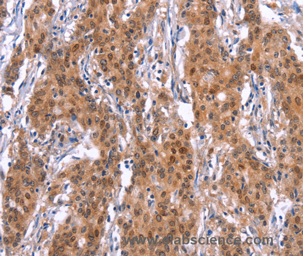 Immunohistochemistry of paraffin-embedded Human gastric cancer tissue using GPR124 Polyclonal Antibody at dilution 1:40