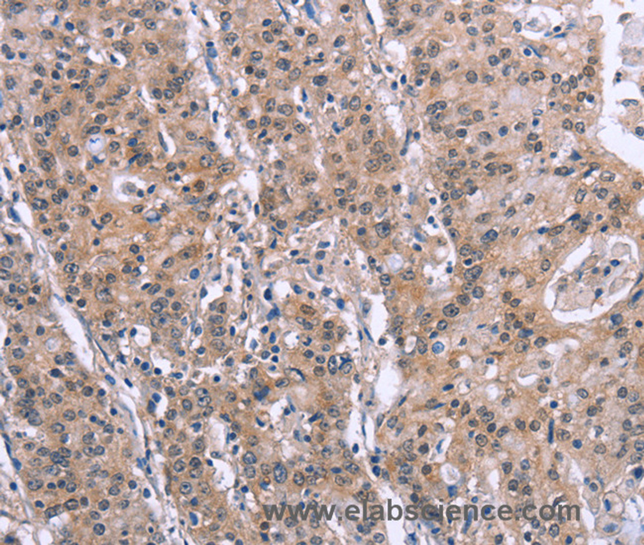 Immunohistochemistry of paraffin-embedded Human gastric cancer tissue using GPR172B Polyclonal Antibody at dilution 1:40