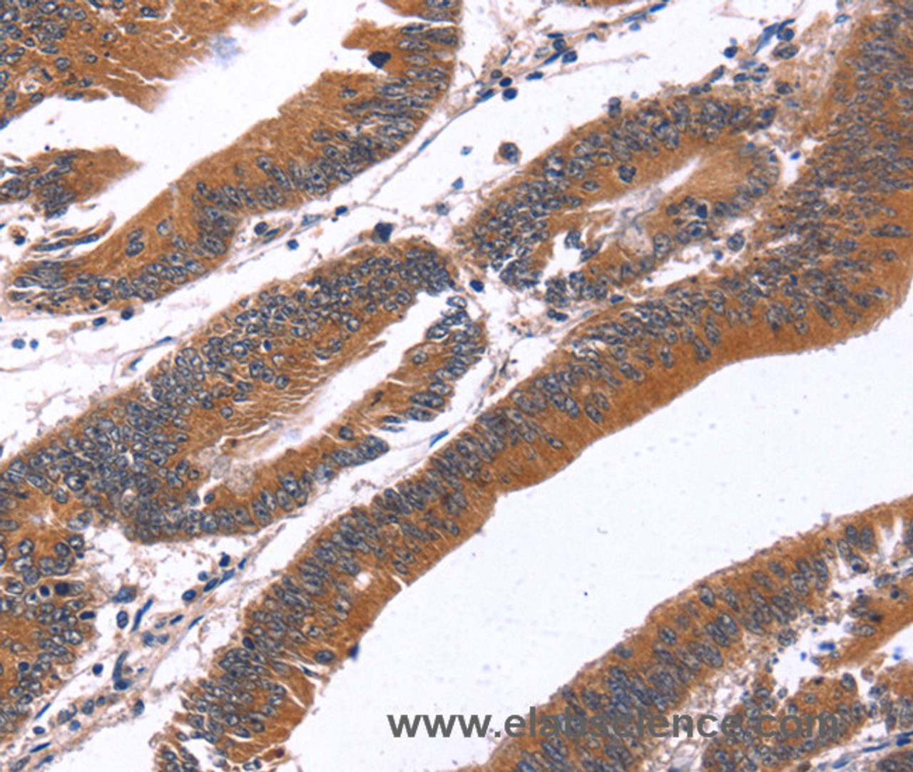 Immunohistochemistry of paraffin-embedded Human colon cancer tissue using GREB1 Polyclonal Antibody at dilution 1:40