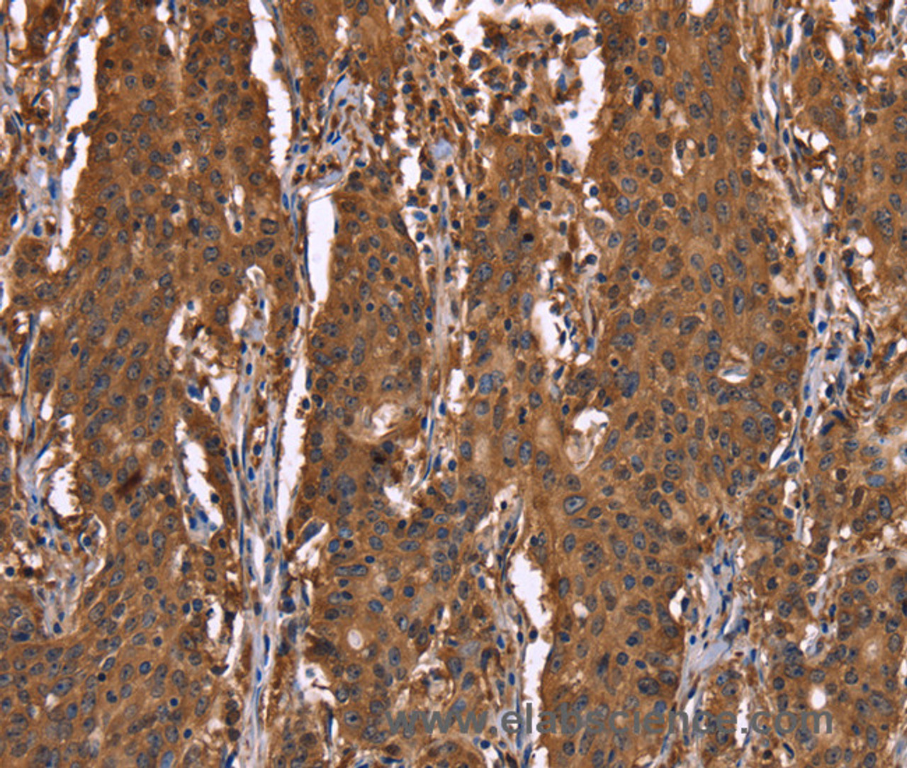 Immunohistochemistry of paraffin-embedded Human gastic cancer using HINT1 Polyclonal Antibody at dilution of 1:30