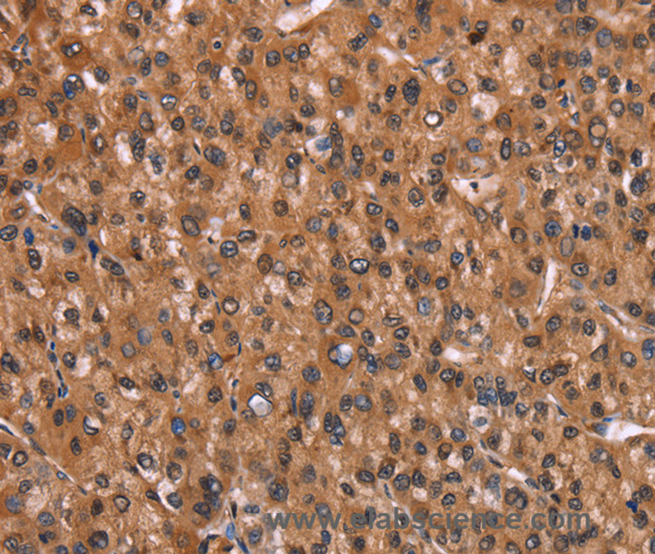 Immunohistochemistry of paraffin-embedded Human liver cancer using HINT1 Polyclonal Antibody at dilution of 1:30