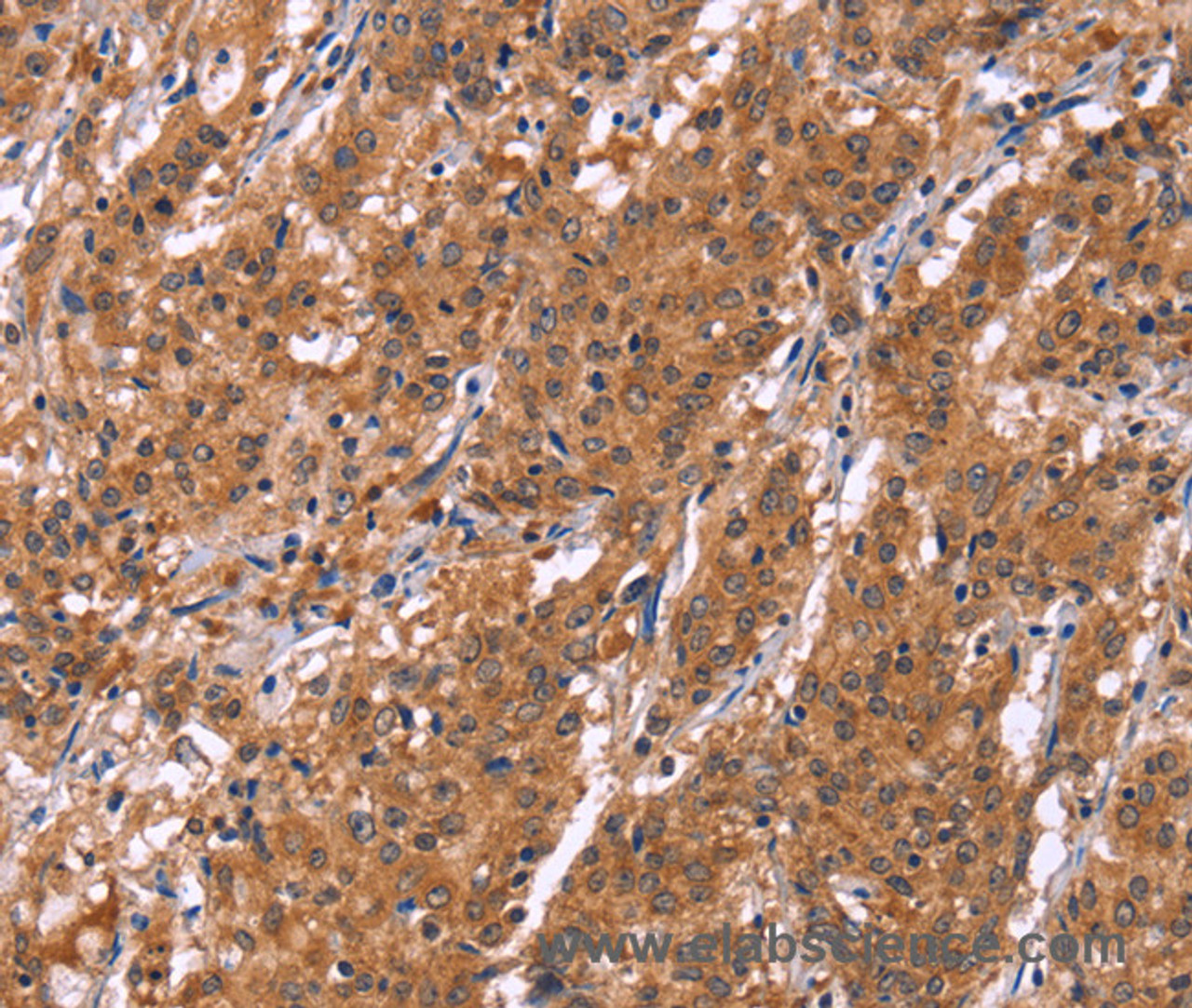 Immunohistochemistry of paraffin-embedded Human gastric cancer tissue using HLTF Polyclonal Antibody at dilution 1:30