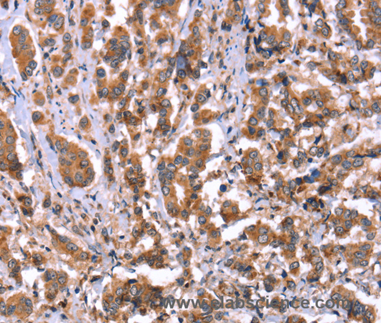 Immunohistochemistry of paraffin-embedded Human breast cancer tissue using HRG Polyclonal Antibody at dilution 1:50