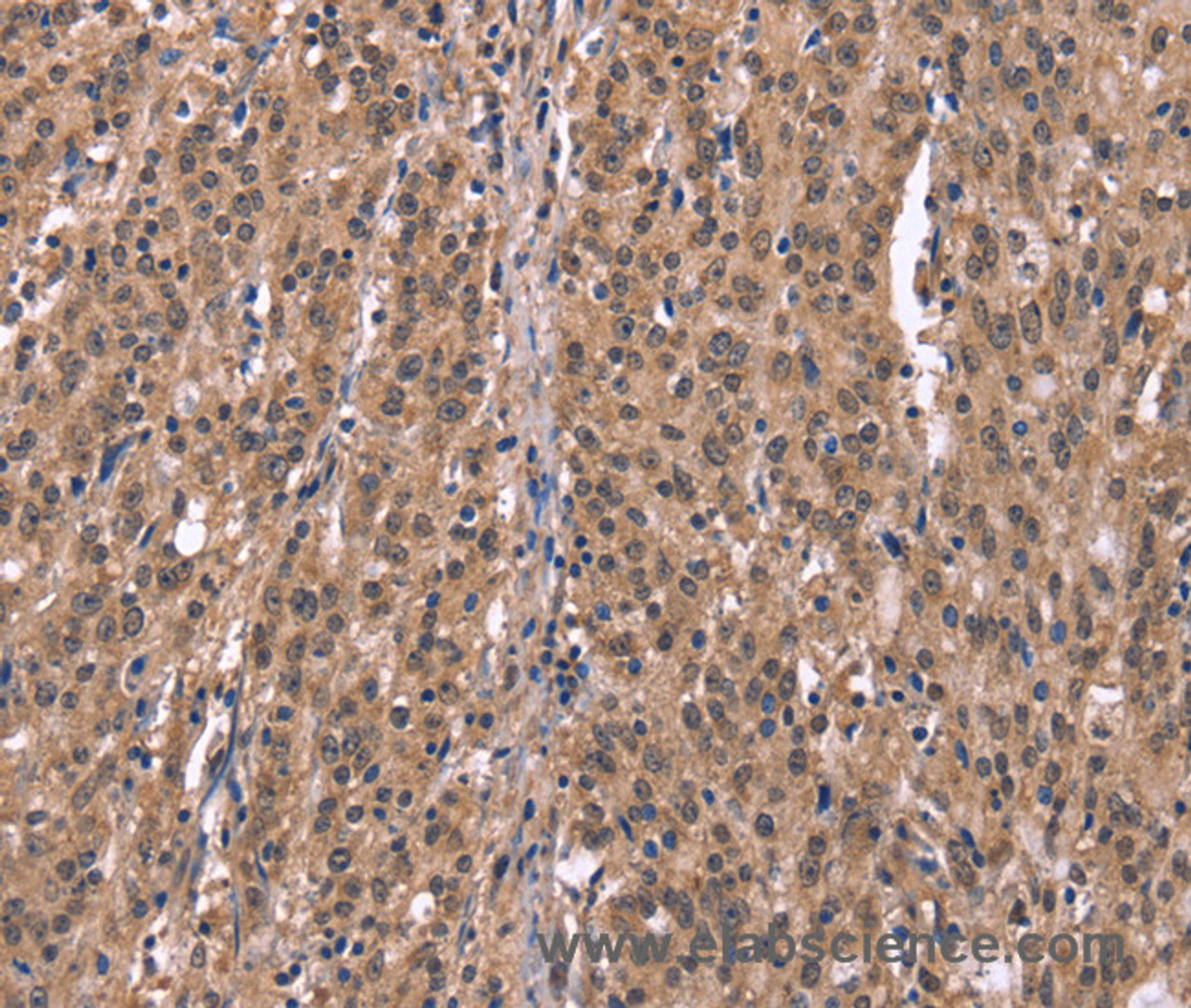 Immunohistochemistry of paraffin-embedded Human gastric cancer using Histamine H1 Receptor Polyclonal Antibody at dilution of 1:40