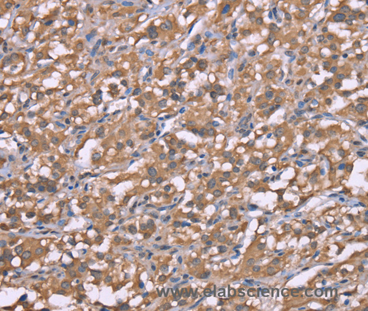Immunohistochemistry of paraffin-embedded Human thyroid cancer using Histamine H3 Receptor Polyclonal Antibody at dilution of 1:50