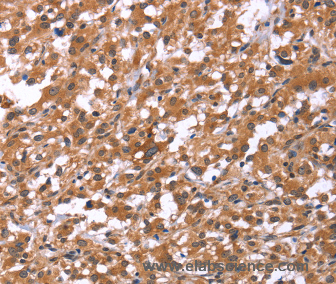 Immunohistochemistry of paraffin-embedded Human thyroid cancer using HSD17B1 Polyclonal Antibody at dilution of 1:40