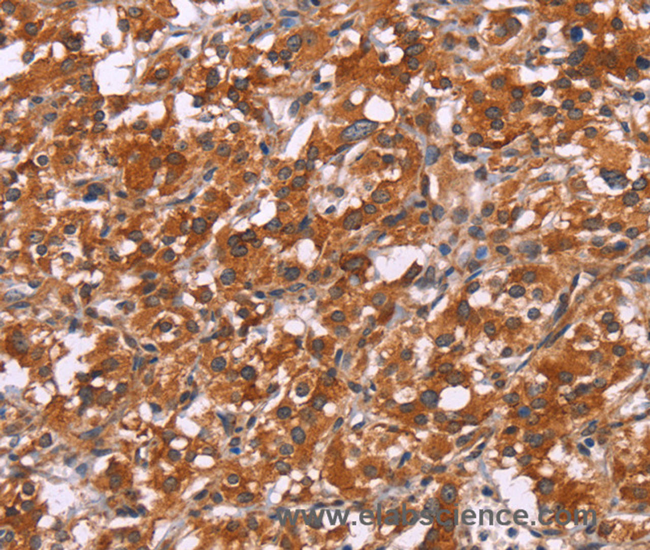Immunohistochemistry of paraffin-embedded Human thyroid cancer tissue using HSPB6 Polyclonal Antibody at dilution 1:30