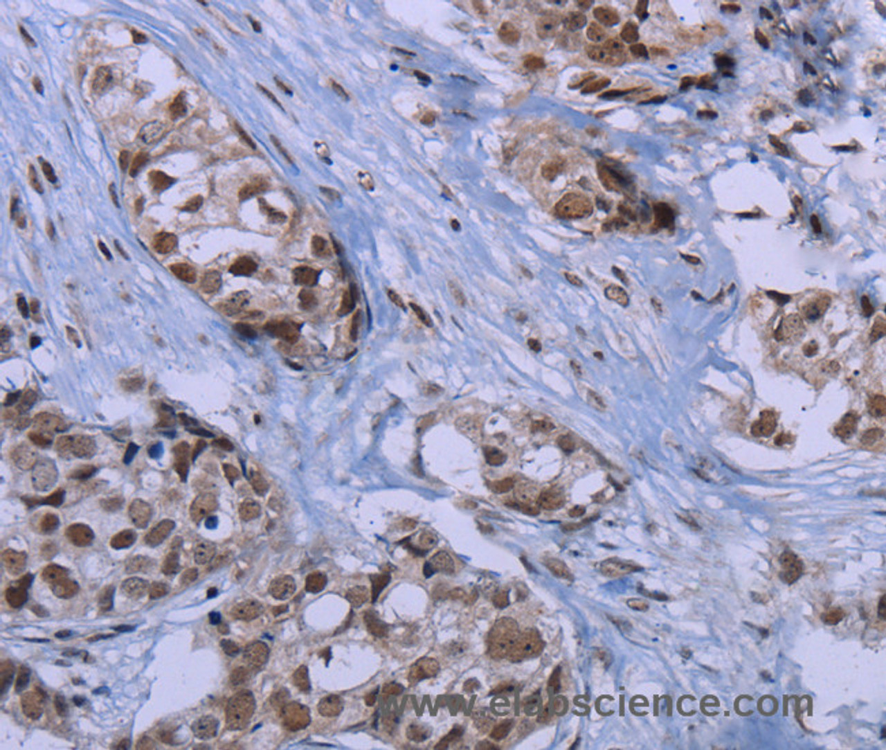 Immunohistochemistry of paraffin-embedded Human breast cancer tissue using ID3 Polyclonal Antibody at dilution 1:40