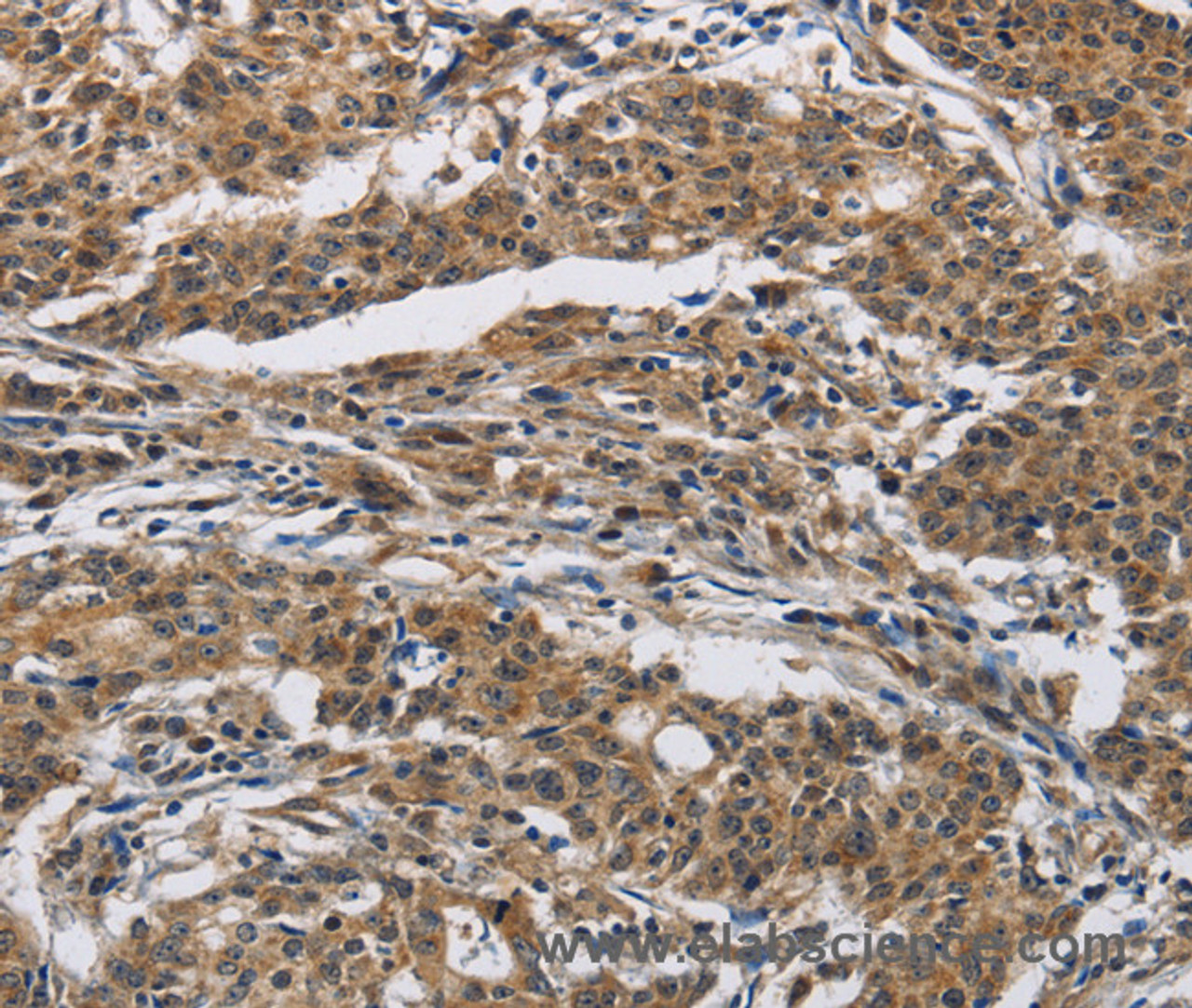 Immunohistochemistry of paraffin-embedded Human gastric cancer using IFNGR2 Polyclonal Antibody at dilution of 1:40