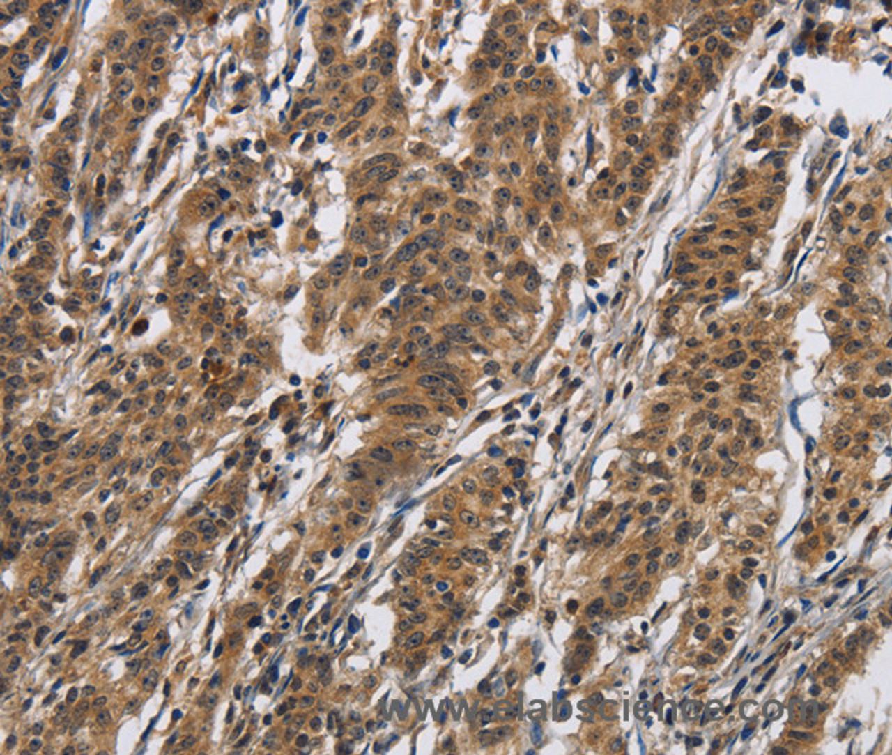 Immunohistochemistry of paraffin-embedded Human gasrtic cancer tissue using IL12RB2 Polyclonal Antibody at dilution 1:40