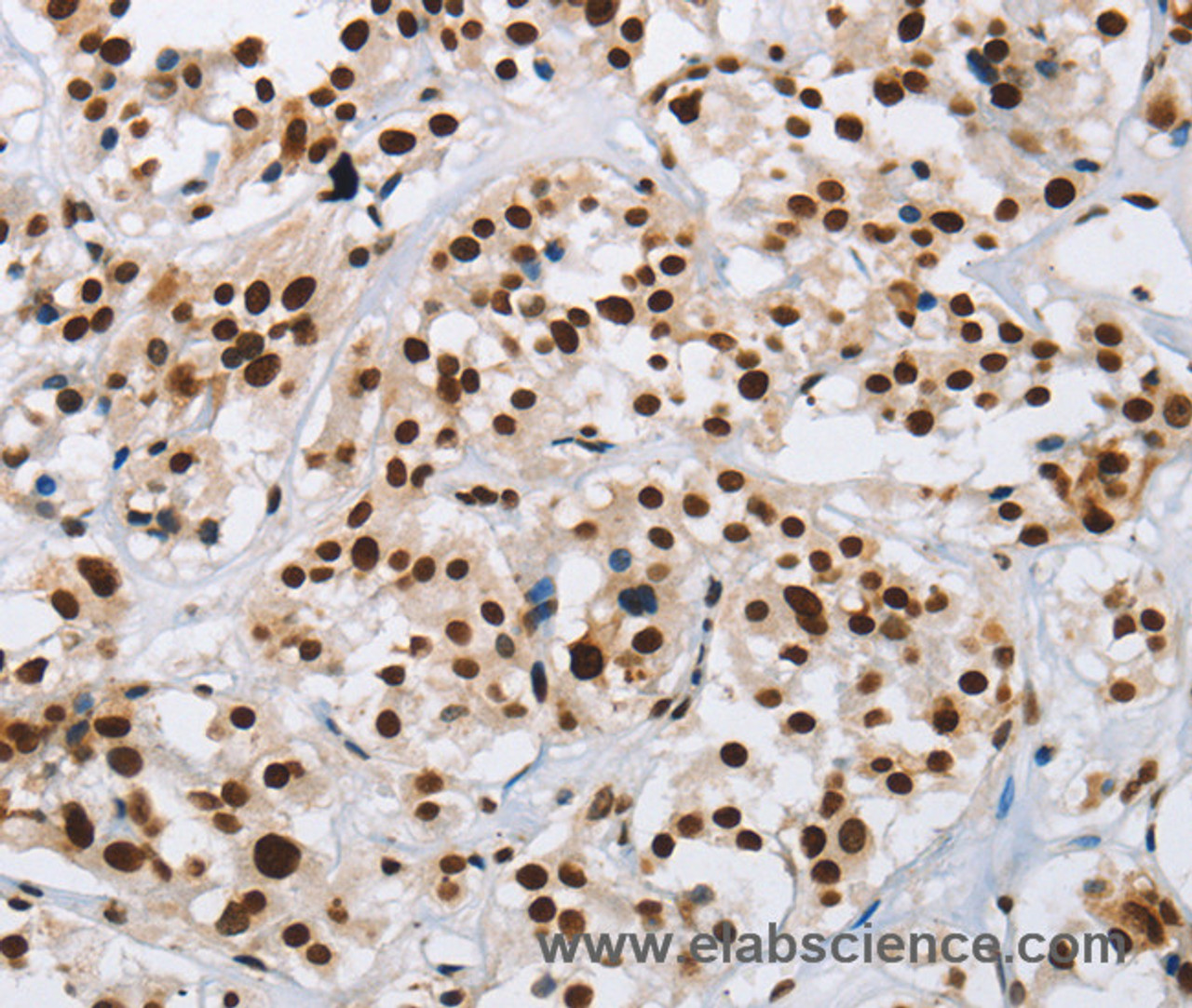 Immunohistochemistry of paraffin-embedded Human thyroid cancer using IL17C Polyclonal Antibody at dilution of 1:50