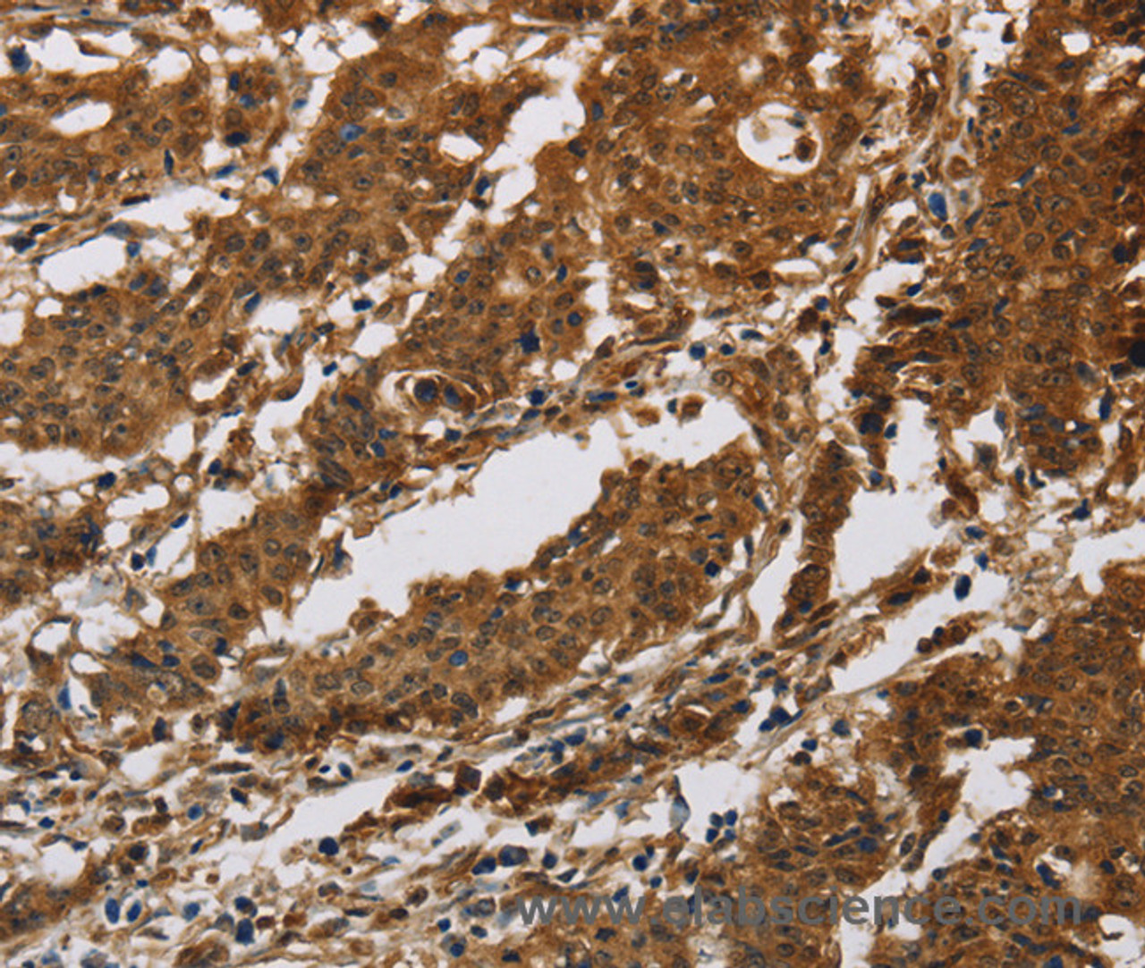 Immunohistochemistry of paraffin-embedded Human gastric cancer tissue using IL17RB Polyclonal Antibody at dilution 1:40