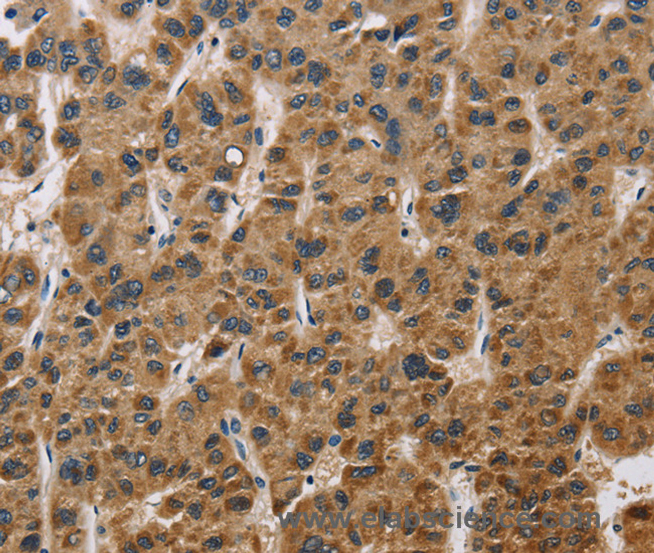 Immunohistochemistry of paraffin-embedded Human liver cancer tissue using IL19 Polyclonal Antibody at dilution 1:40