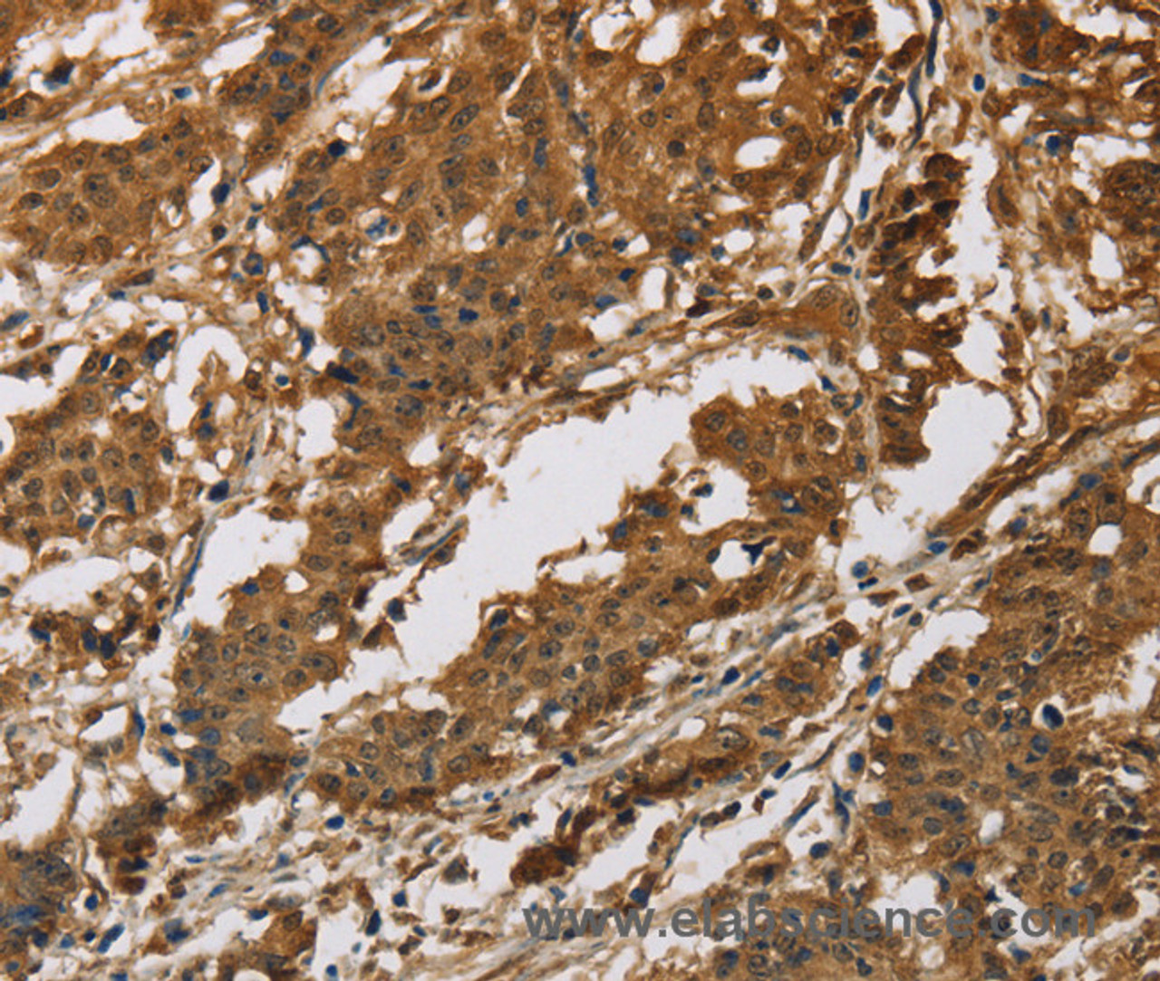 Immunohistochemistry of paraffin-embedded Human gastric cancer tissue using IL19 Polyclonal Antibody at dilution 1:40
