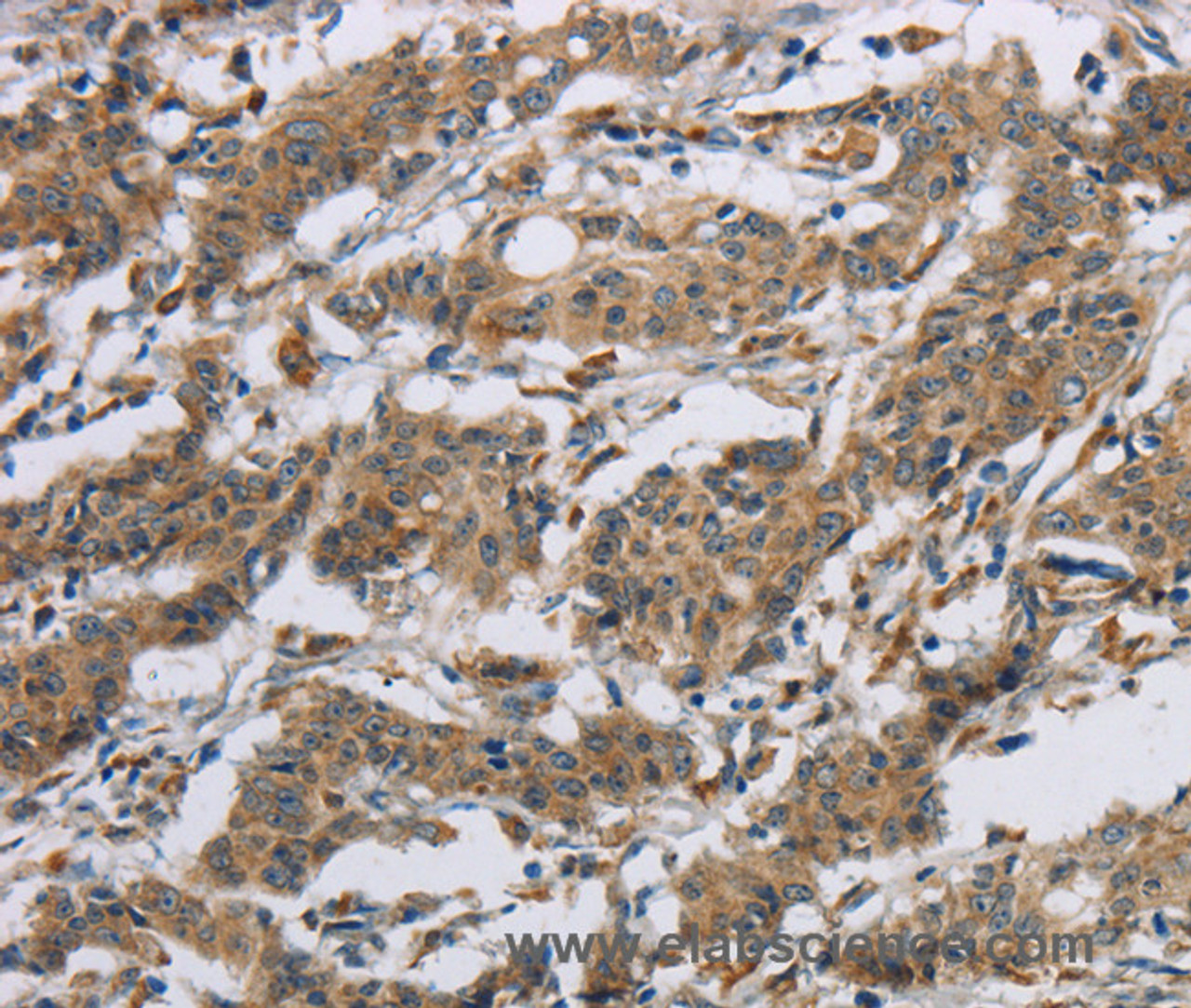 Immunohistochemistry of paraffin-embedded Human gastic cancer using SYN2 Polyclonal Antibody at dilution of 1:40