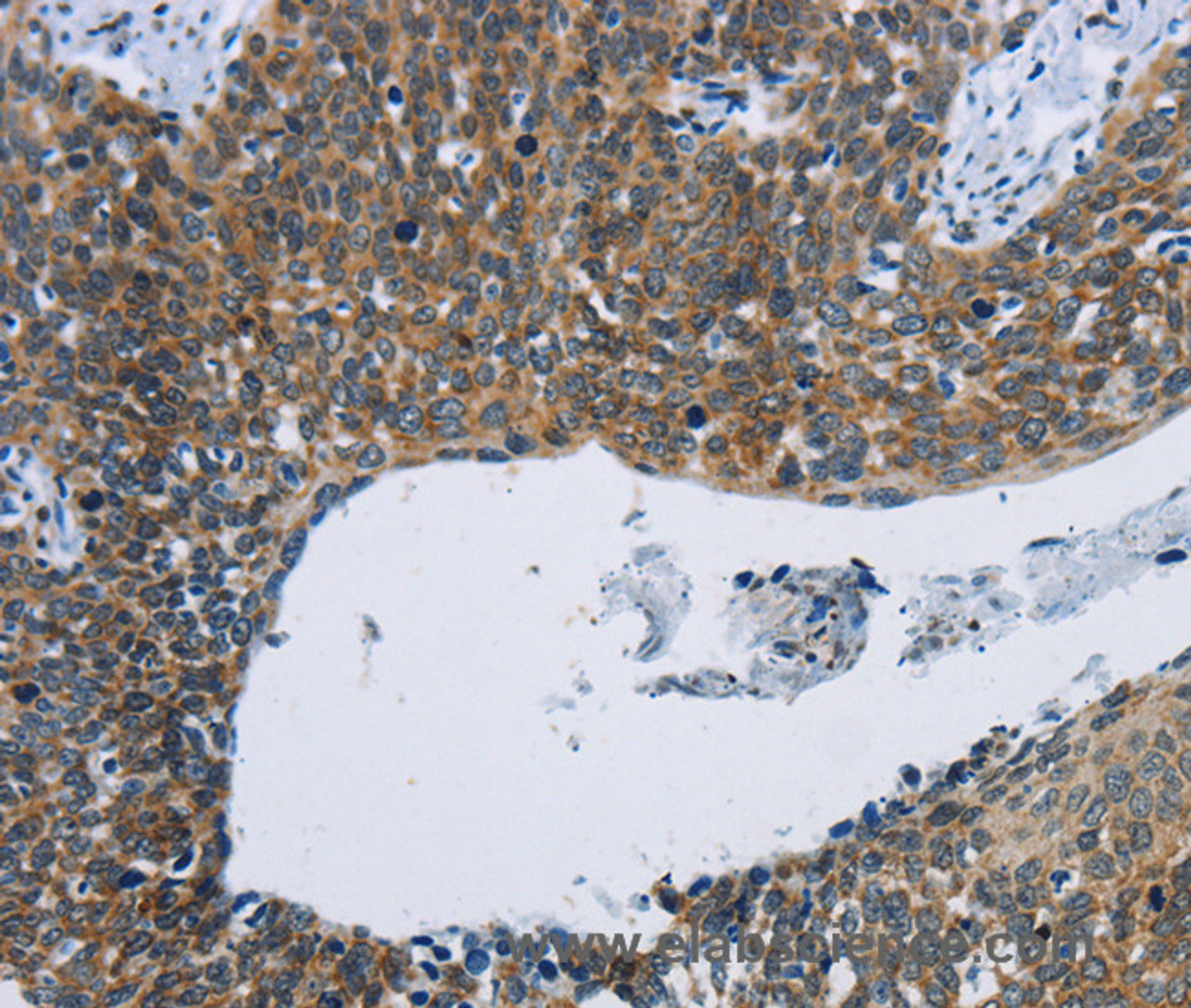 Immunohistochemistry of paraffin-embedded Human cervical cancer tissue using KPNB1 Polyclonal Antibody at dilution 1:40