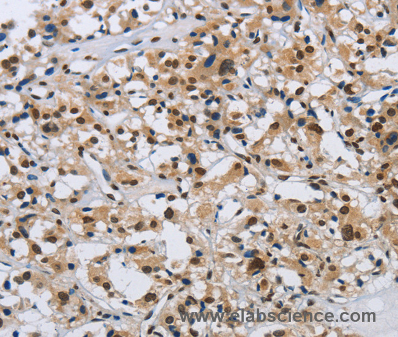 Immunohistochemistry of paraffin-embedded Human thyroid cancer tissue using KPNB1 Polyclonal Antibody at dilution 1:40