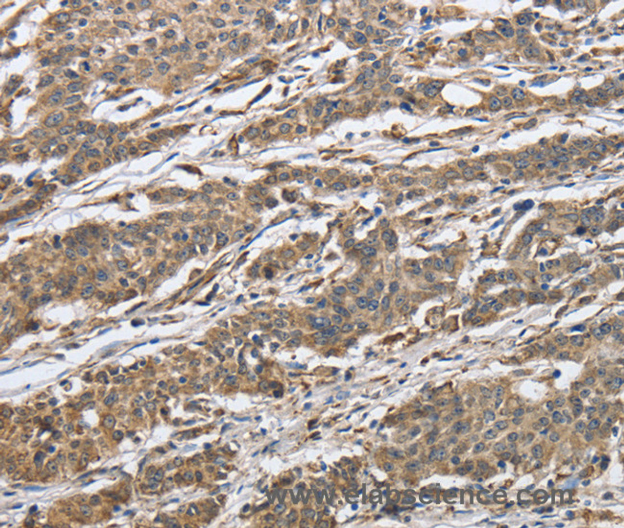 Immunohistochemistry of paraffin-embedded Human gastic cancer using IPO7 Polyclonal Antibody at dilution of 1:40